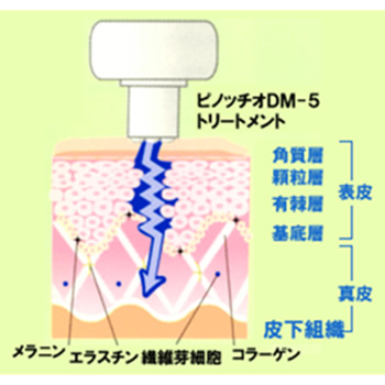 エステ美容機器＞ BeBe pinocchio DM-5 （ベベピノッチオDM-5